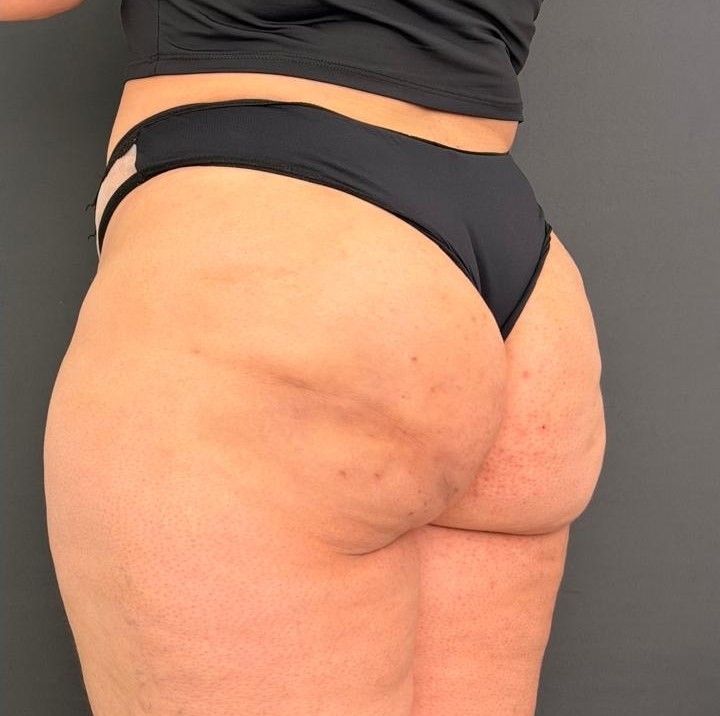 Depois: Remodelação glútea com resultados visíveis