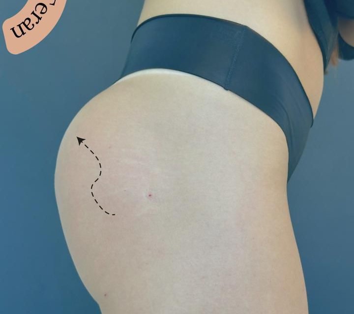 Depois: Resultado bioestimulador corporal